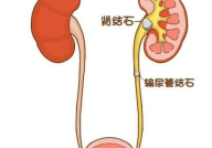 如何缓解肾结石疼痛,肾结石疼痛缓解策略全解析